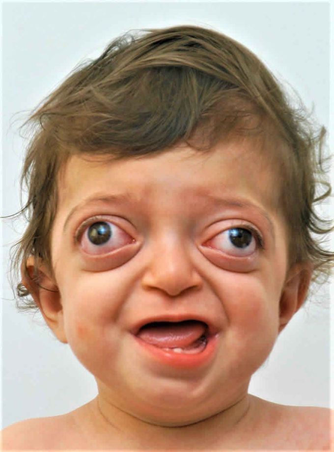 Crouzon syndrome