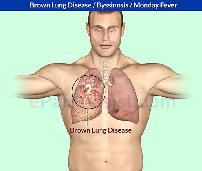 Byssinosis
