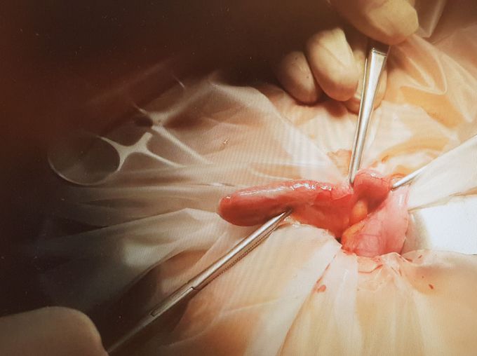 Appendix Operation