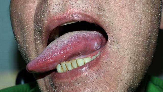 Tongue cancer causes
