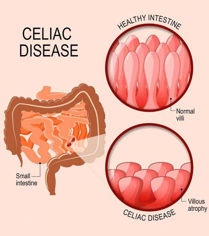 Causes of coeliac disease