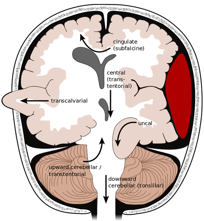 Herniation Secondary to Raised Intracranial Pressure