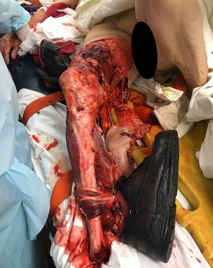 Motor vehicle accident