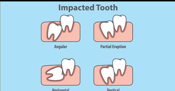 Impacted tooth