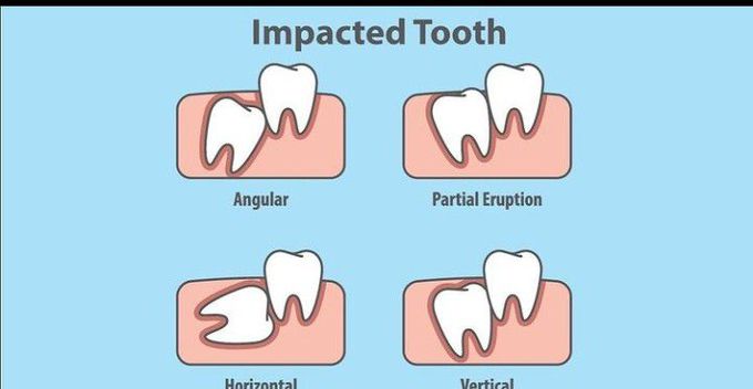 Impacted tooth - MEDizzy