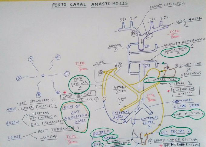 Portacaval Anastomosis