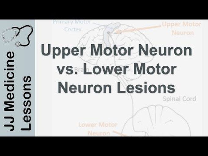 Upper and Lower Motor Neuron Lesions