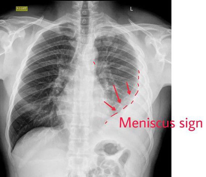 PLEURAL EFFUSION