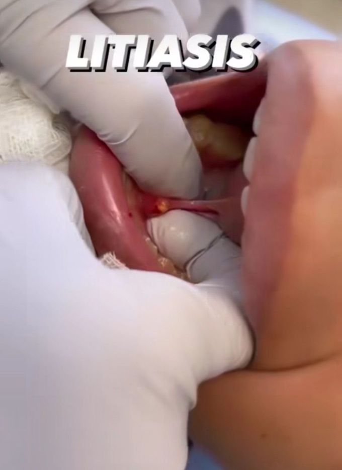 Lithiasis