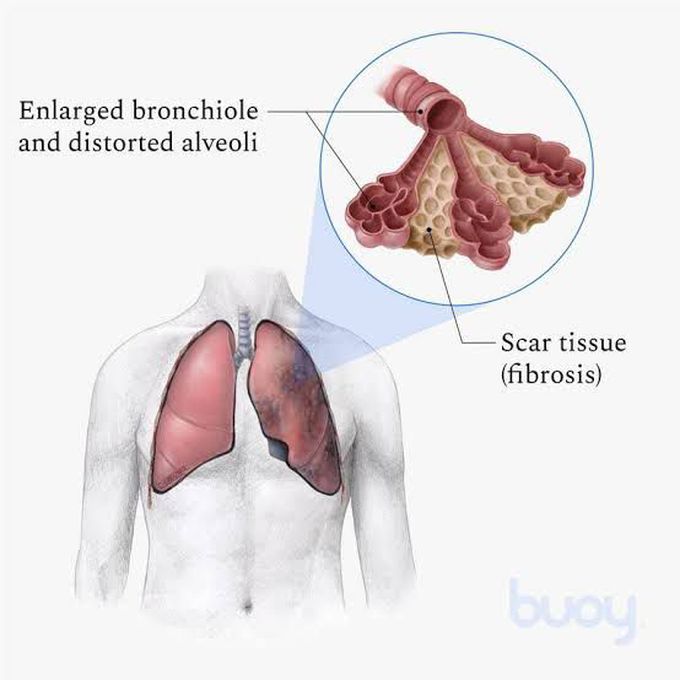 Causes of pulmonary fibrosis