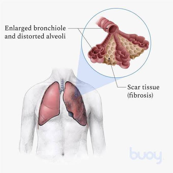 Causes Of Pulmonary Fibrosis Medizzy