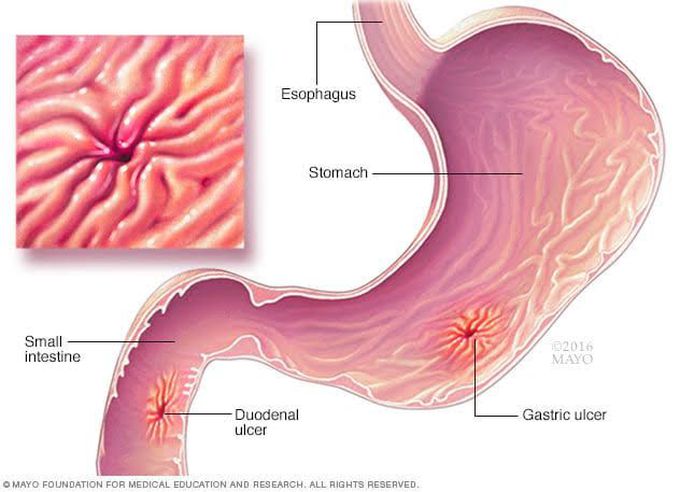 Peptic ulcer