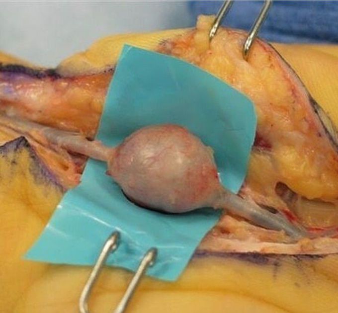 Ulnar artery aneurysm
