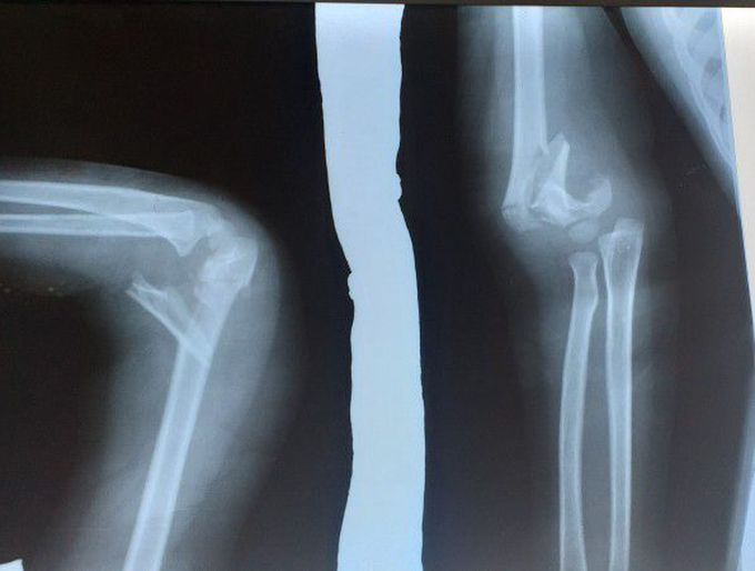 Whic bone is broken and what manage operation or stablishing