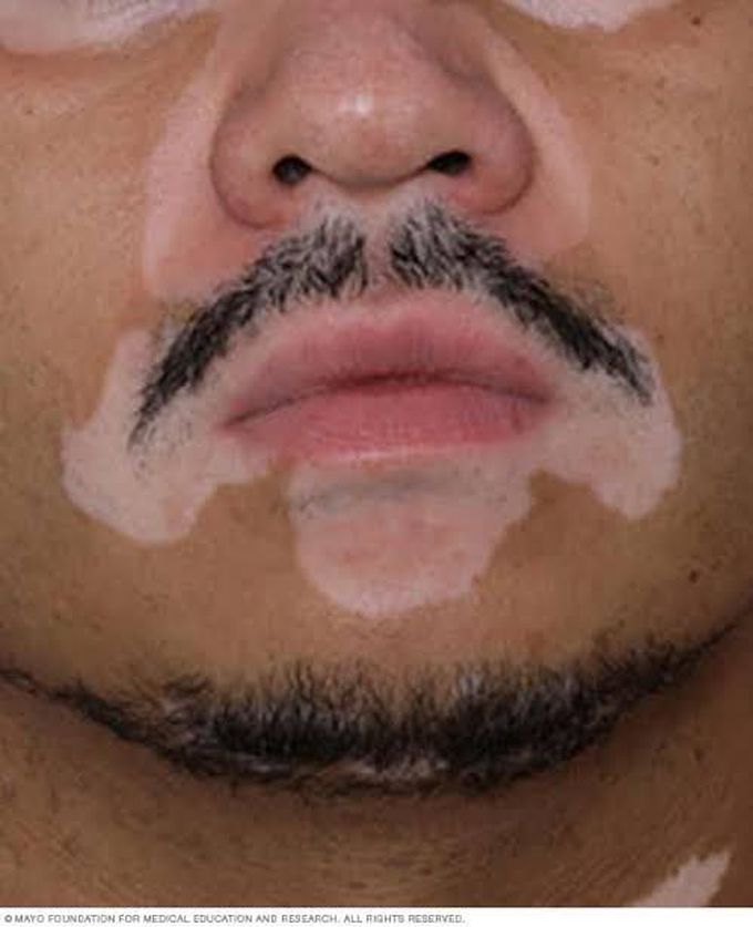 Vitiligo