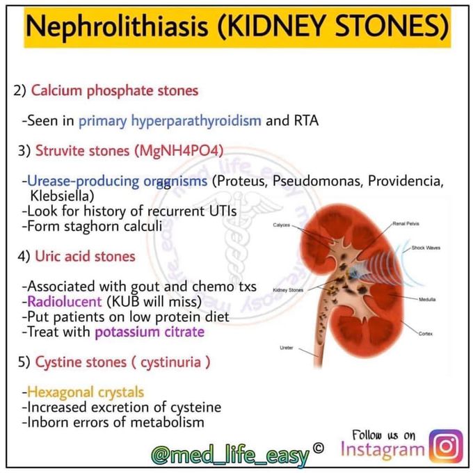 Kidney stones