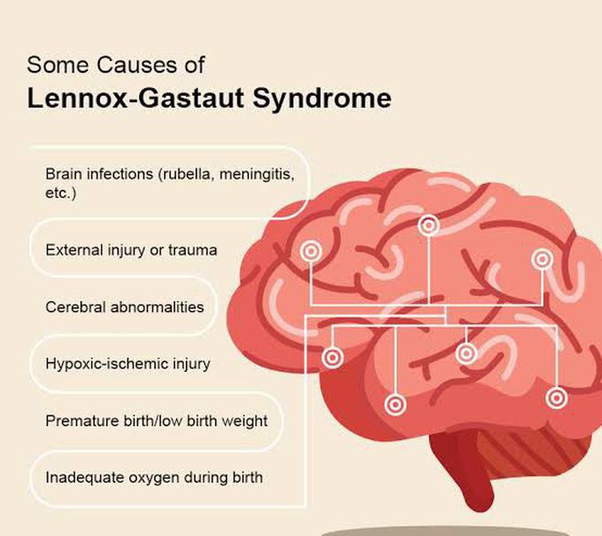 These are the causes of Lennox gastaut syndrome