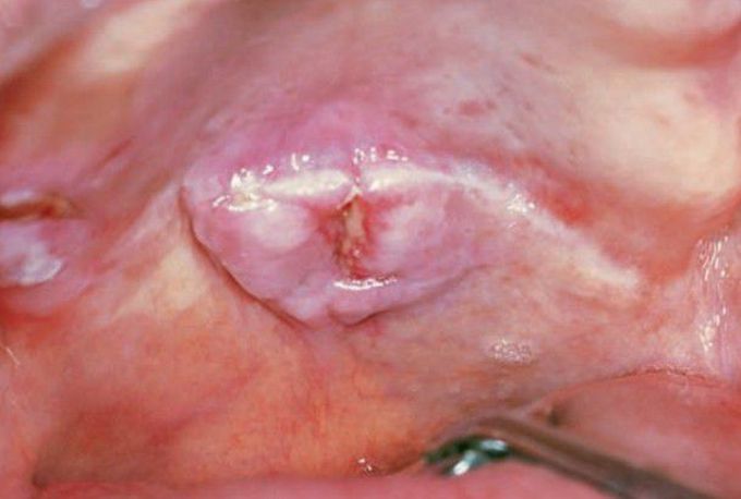Mucoepidermoid carcinoma