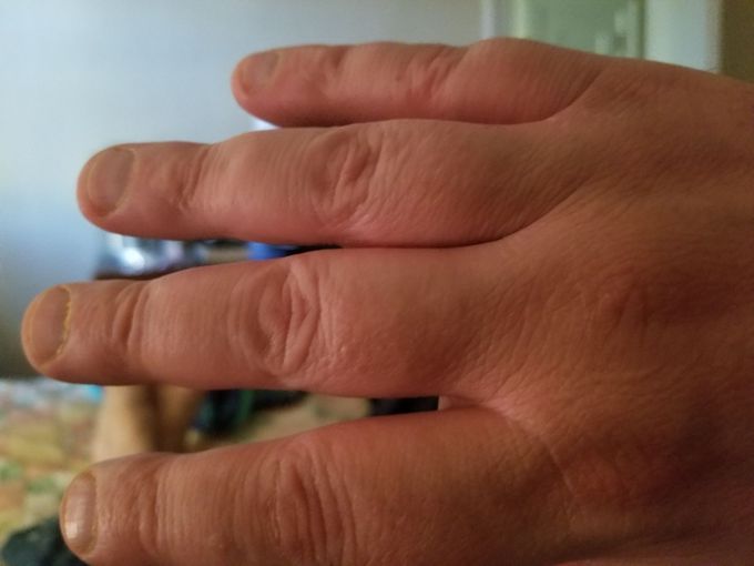 Heart attack hands