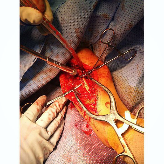Fixing a humerus fracture and showing the radial nerve as it winds around the humerus!