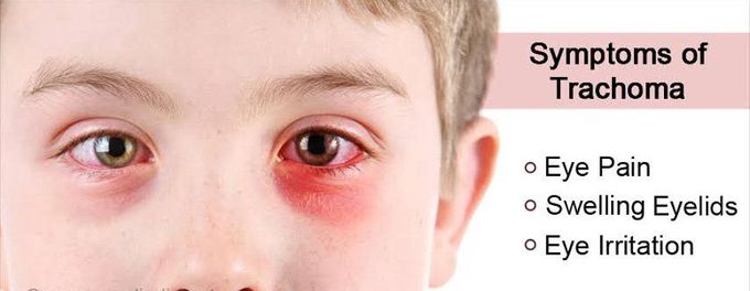 Trachoma symptoms