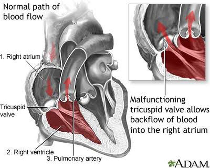 Tricuspid regurgitation - MEDizzy