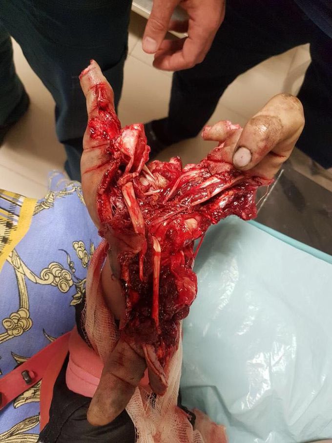Trauma por explosivo