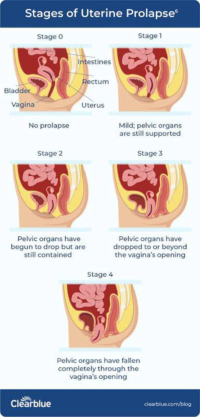 Stages of Uterine Prolapse