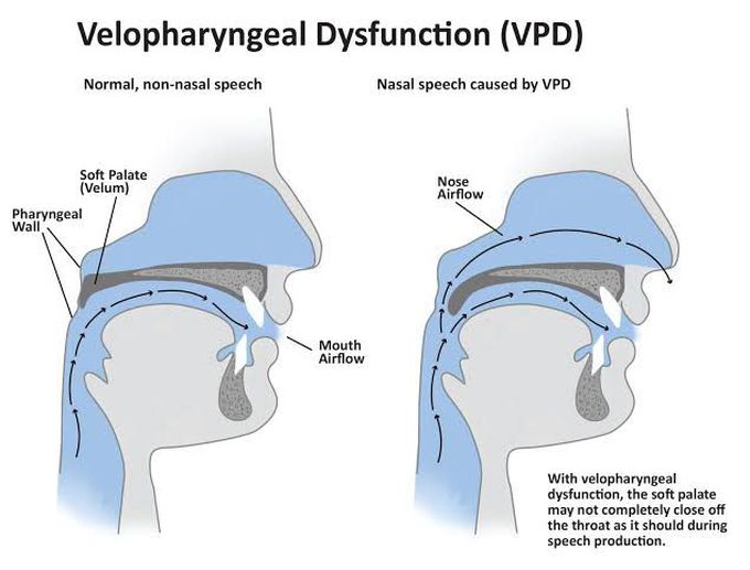 Symptoms of velopharyngeal insufficiency