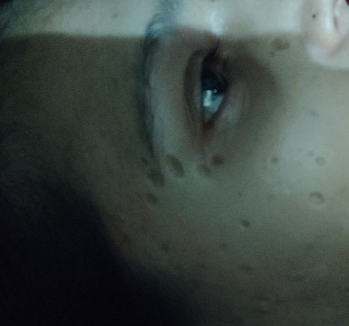 Chicken pox
