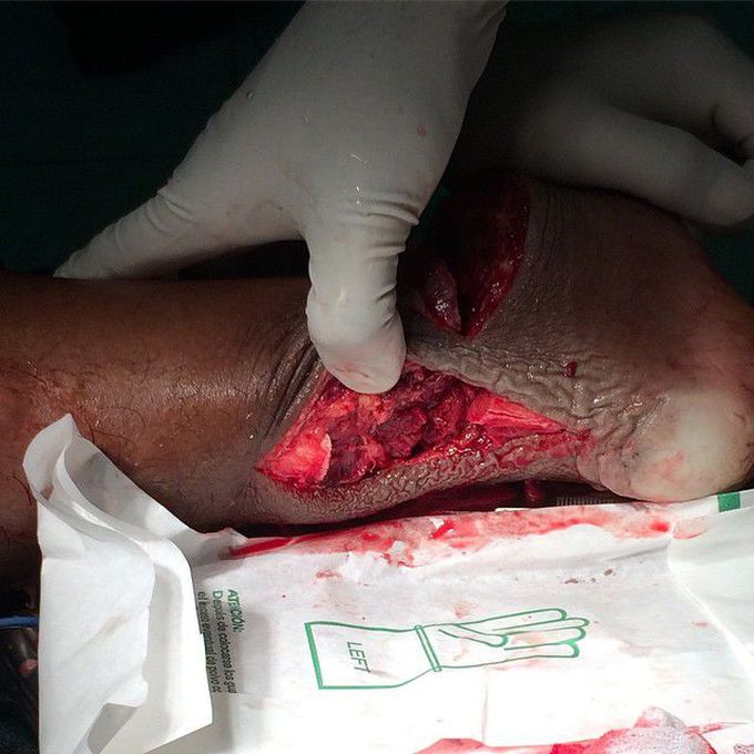 Achilles tendon rupture...clean cut