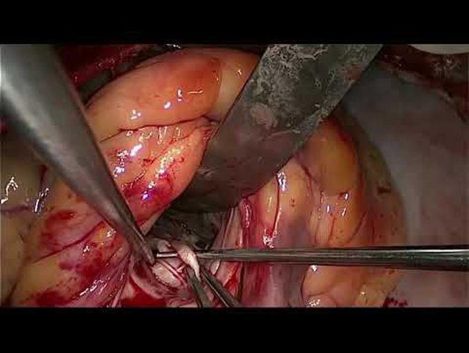 Rare Case of Biventricular HOCM With Severe Mitral Incompetence