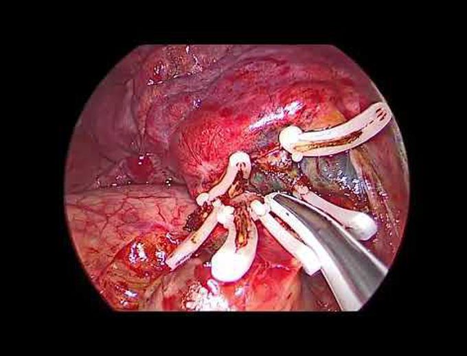 Uniportal Left Upper Trisegmentectomy (S1+2+3)
