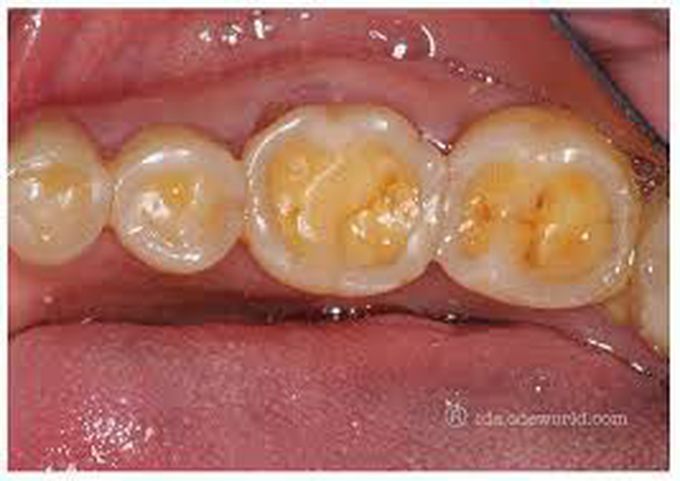Dental erosion