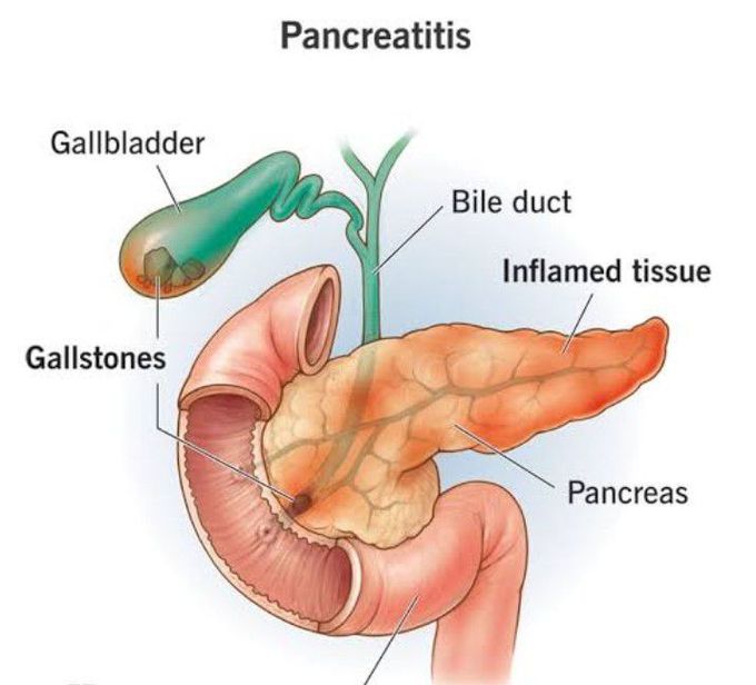 Pancreatitis