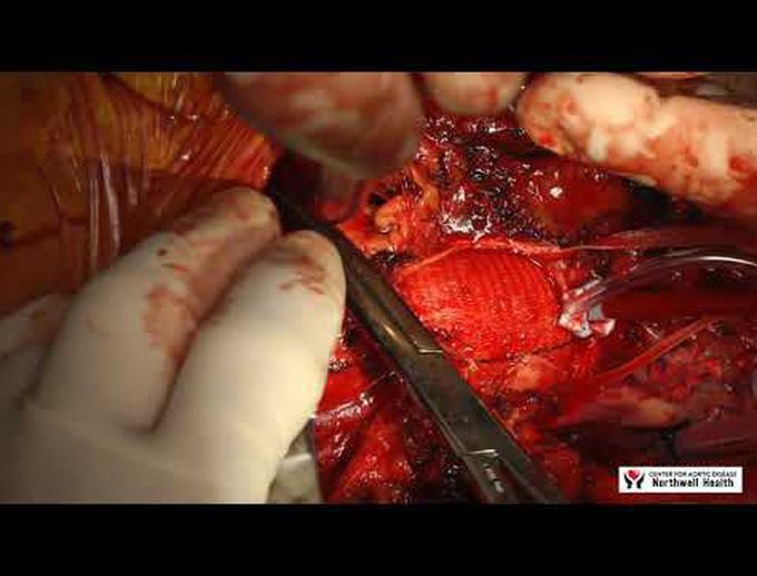 Reoperative Ruptured Aortic Arch