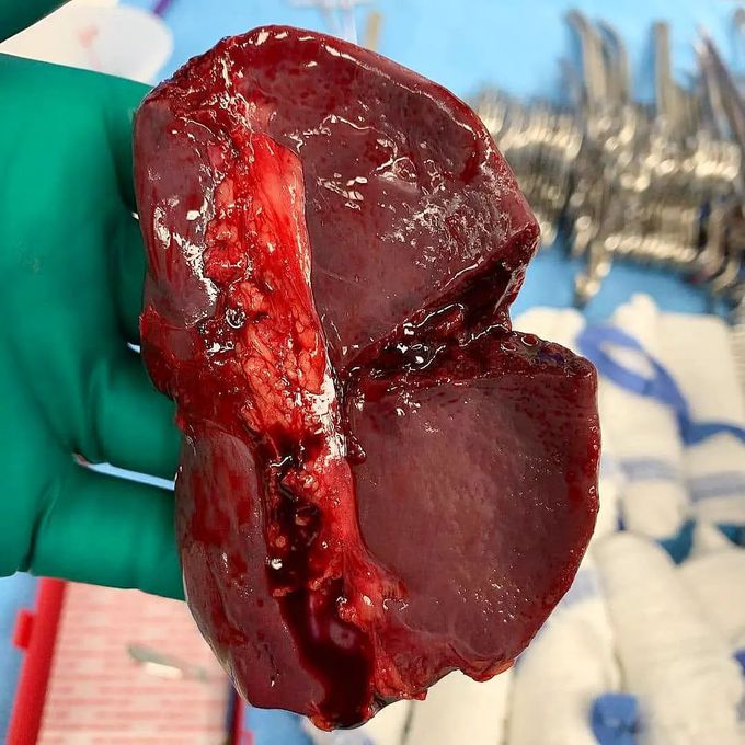 Splenic rupture