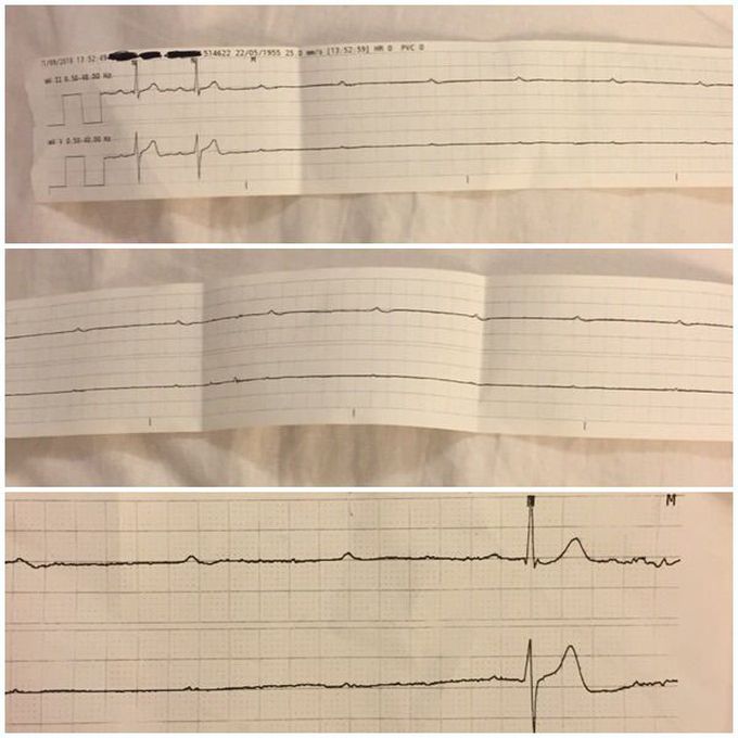 30 second ventricular standstill