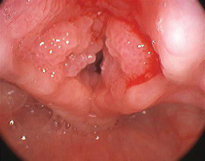 Respiratory papillomatosis