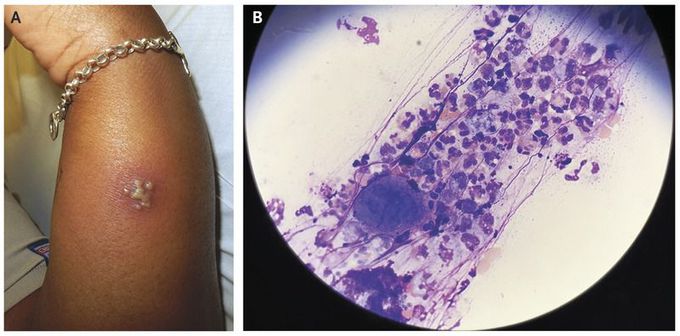 Grouped Pustules on an Erythematous Base