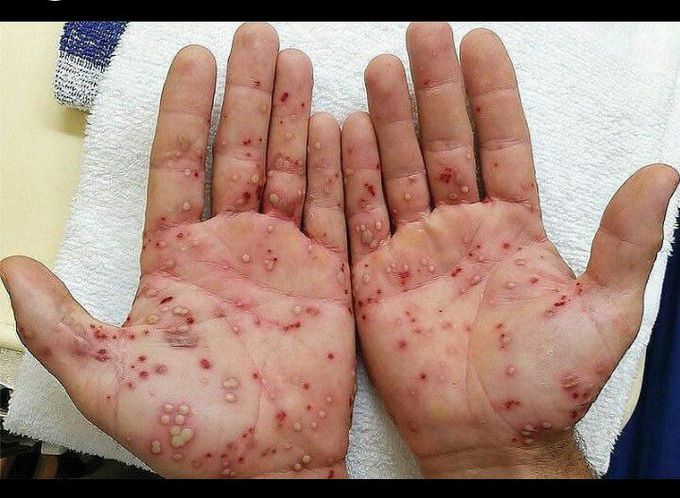 Poststreptococcal Pustulosis