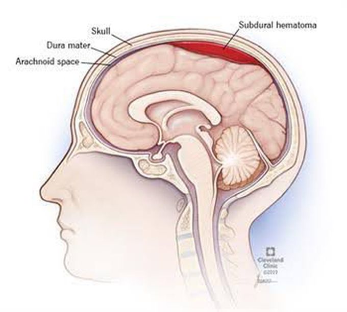 Subdural hematoma symptoms