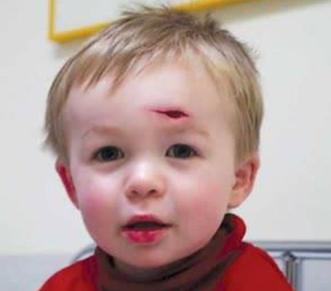 Young child with 3cm facial laceration – closure method? - MEDizzy