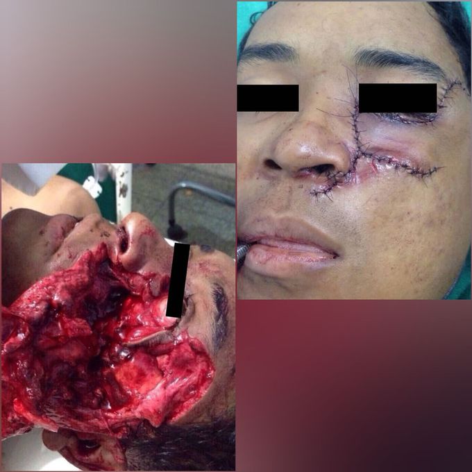 A bull rider was hospitalized with serious injuries after a bull stepped on his face at a rodeo!