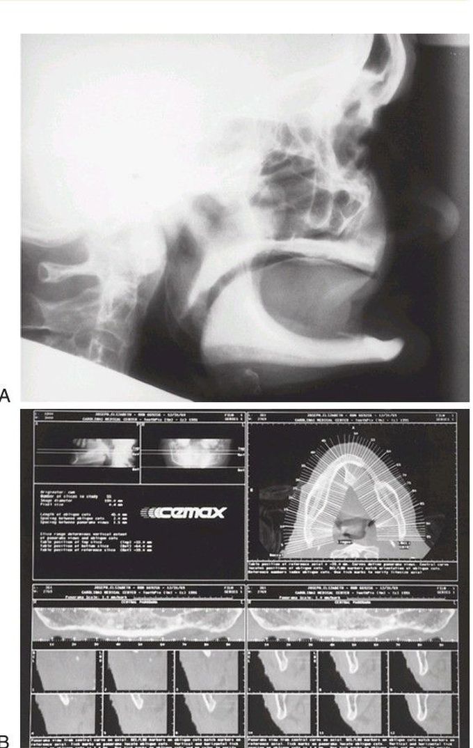 Anatomy of mandible