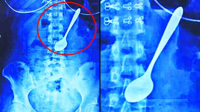 Top 10 Weirdest Things Removed From The Human Body