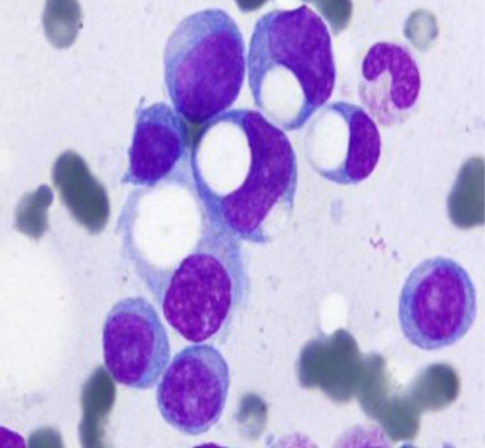 Signet-Ring Plasma Cells