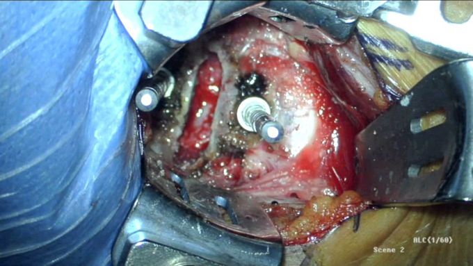 Hybrid cervical disc arthroplasty
