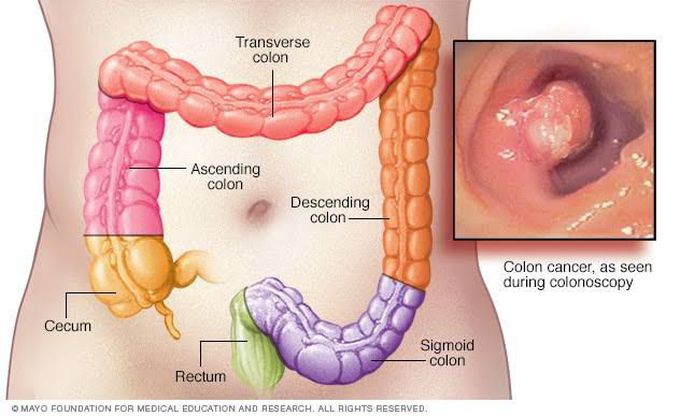 Symptoms of colon cancer