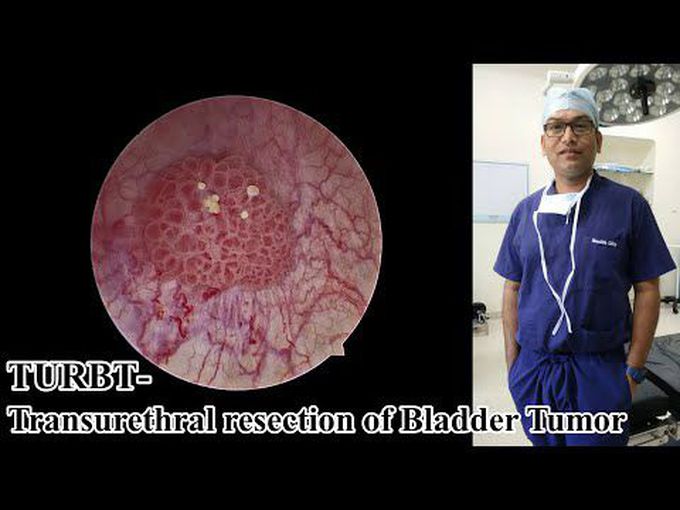 Transurethral Resection of Bladder Tumor (TURBT)